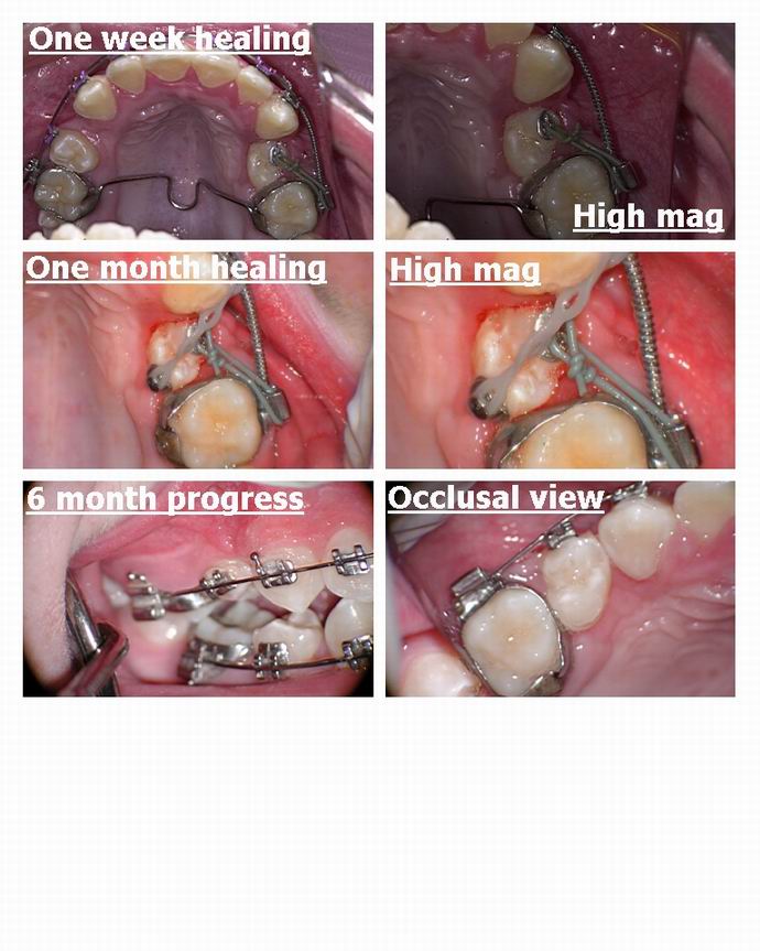 Resize of Exposure of premolar pg 4.jpg